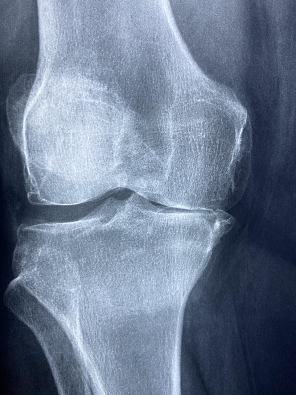 Knee X-ray used to assess osteoarthritis progression